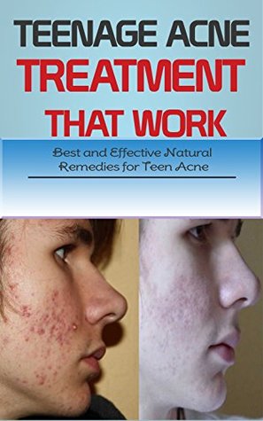 Read Teenage Acne Treatment That Work: Best and Effective Natural Remedies for Teen Acne - Marina Ryan file in ePub