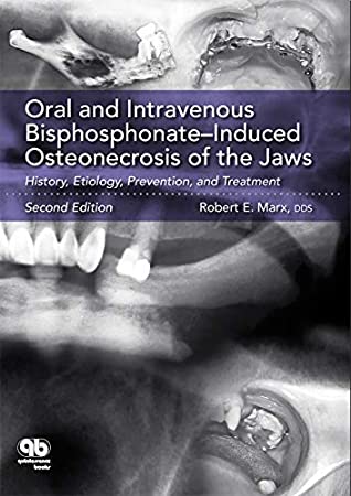 Read Online Oral and Intravenous Bisphosphonate–Induced Osteonecrosis of the Jaws: History, Etiology, Prevention, and Treatment, Second Edition - Robert E. Marx | PDF